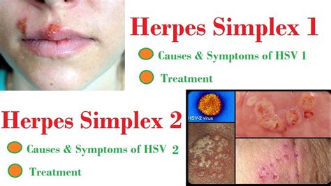 herpes simple-1